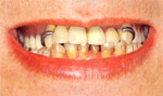 水野歯科クリニック　入れ歯　マグネット式　治療前